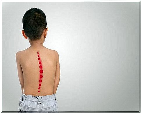Child with scoliosis
